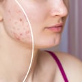 Improving Skin Conditions: The Importance of Water Filtration Systems
