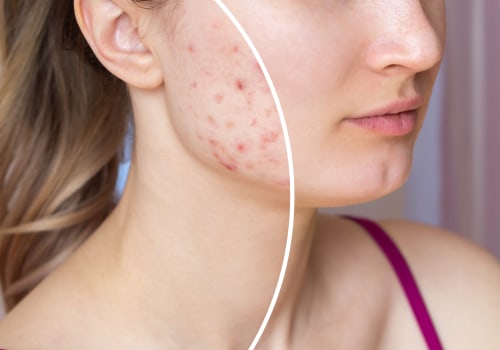 Improving Skin Conditions: The Importance of Water Filtration Systems